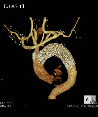遠位弓部大動脈瘤に対する頸部分枝再建[image]