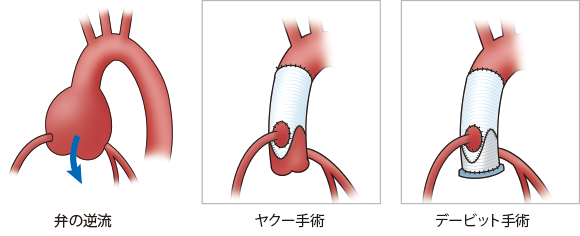 倉敷中央病院 医療従事者の方へ 低侵襲心血管手術 Mics Opcab 自己弁温存 再建の取り組み 倉敷中央病院 医療従事者の方へ 低侵襲心血管手術 Mics Opcab 自己弁温存 再建の取り組み