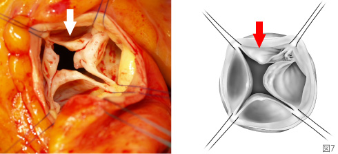 四尖弁の大動脈弁【術前】