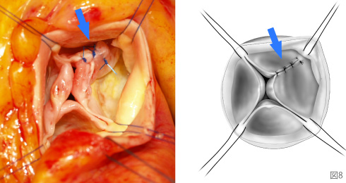 四尖弁の大動脈弁【術後】