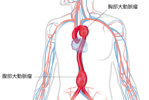 大動脈疾患：大動脈瘤