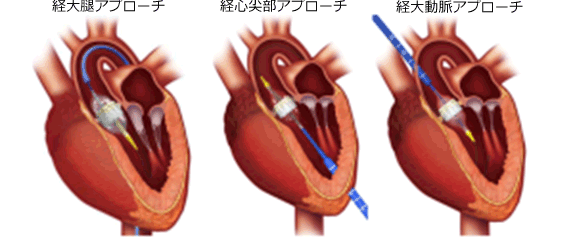 TAVI アプローチの種類