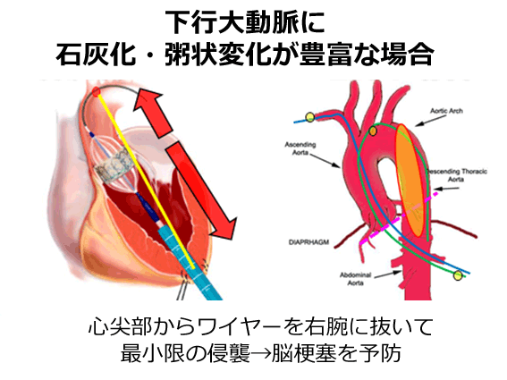 経心尖部・経大動脈アプローチの特徴