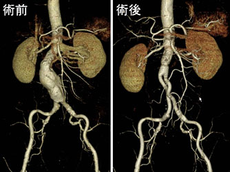 腹部大動脈瘤小切開手術術前術後