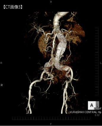 腹部大動脈症例[image]