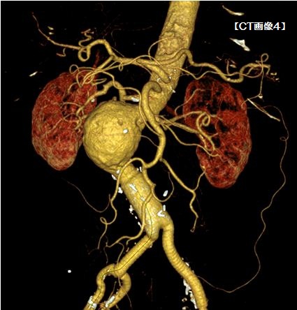 上腸間膜動脈、両側腎動脈が絡んだ動脈瘤症例[image]