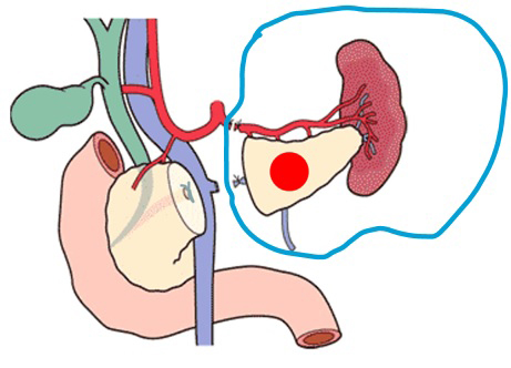 膵体尾部切除の切除範囲 （MEDICAL VIEW社刊「インフォームドコンセントTool 消化器外科イラストLIBRARY」から引用改変）