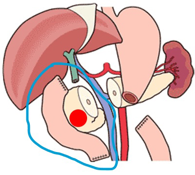 膵頭十二指腸切除の切除範囲 （MEDICAL VIEW社刊「インフォームドコンセントTool 消化器外科イラストLIBRARY」から引用改変）