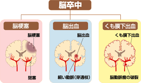 脳卒中の分類 画像