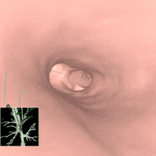 図3  VAL-MAP 仮想気管支鏡画像