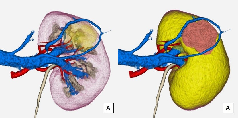 腎癌術前画像