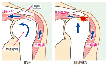 板 肩 損傷 腱