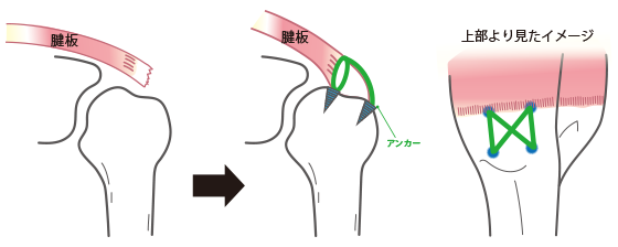 腱板断裂の治療方法 図