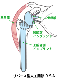 リバース型人工関節 図