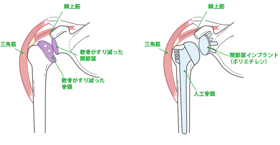 反復性肩関節脱臼 図