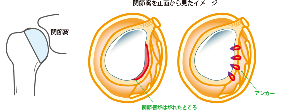 肩関節脱臼治療 図