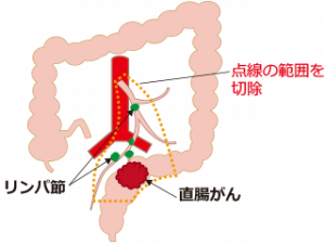 直腸がん手術のイメージ図