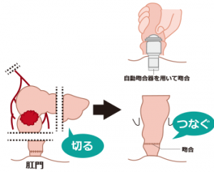 手術は「切除」 + 「吻合」