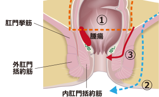 括約筋間直腸切除術（ISR）