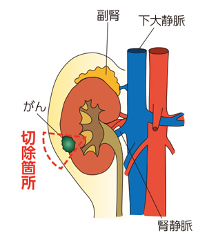 腎部分切除術