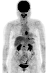 FDG-PET/CT: 食道癌リンパ節転移