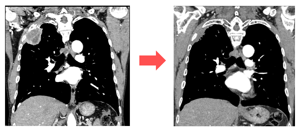 Fig 7. 胸壁浸潤肺癌