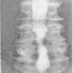 脊髄造影（ミエログラフィー）