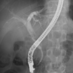 ERCP