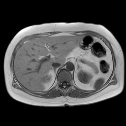 腹部MRI画像