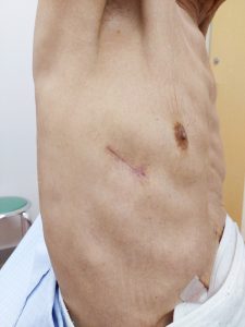 単孔式胸腔鏡手術 実際の創部の様子。外来にて