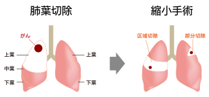 図2 VAL-MAP 肺葉切除と縮小手術