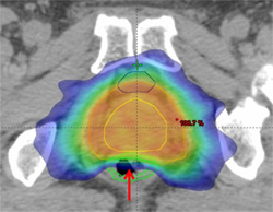 図1　前立腺IMRT線量分布図
