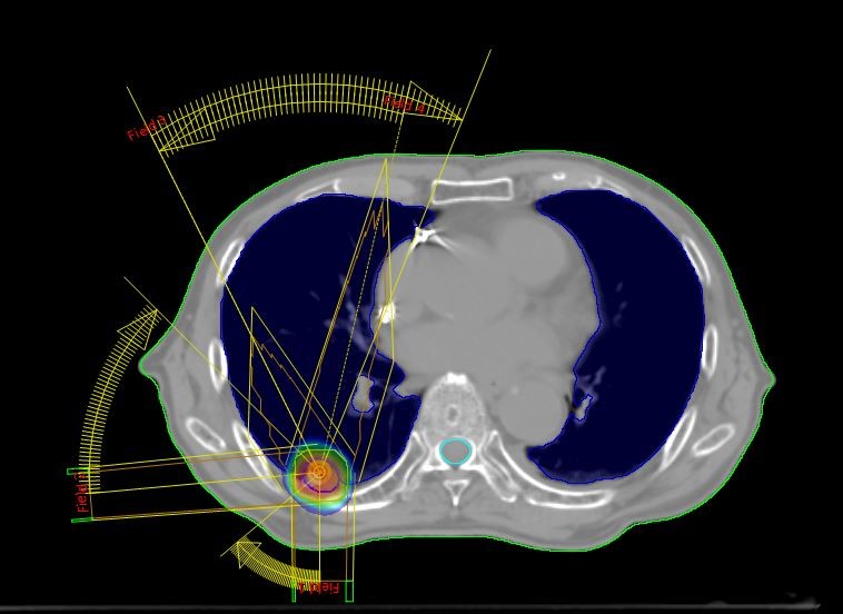 定位放射線治療の例 肺がん