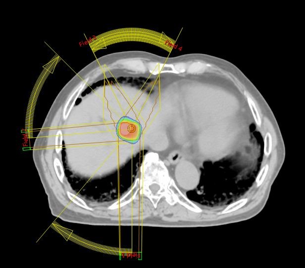 定位放射線治療の例 肝臓がん