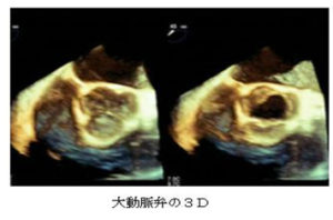 大動脈弁の3D