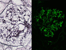 腎生検PAM染色/蛍光抗体法