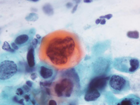 癌細胞（パパニコロウ染色）