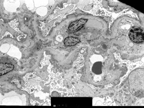 糸球体腎炎の電子顕微鏡像
