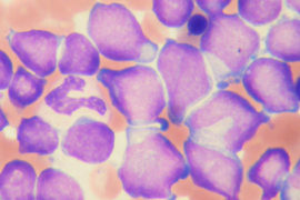 顕微鏡で見える白血病細胞