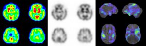 左から脳血流シンチ定量（カラー）画像、定性（白黒）画像、統計解析画像