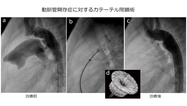 動脈管開存症に対するカテーテル閉鎖術