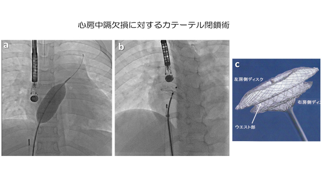 心房中隔欠損に対するカテーテル閉鎖術