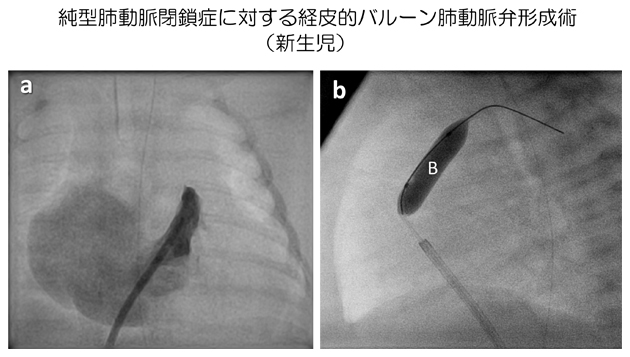 純型肺動脈閉鎖症に対する経皮的バルーン肺動脈弁形成術（新生児）