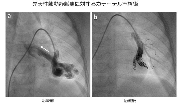 先天性肺動静脈瘻に対するカテーテル塞栓術