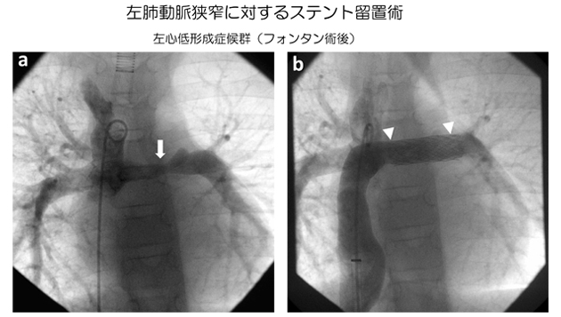 左肺動脈狭窄に対するステント留置術