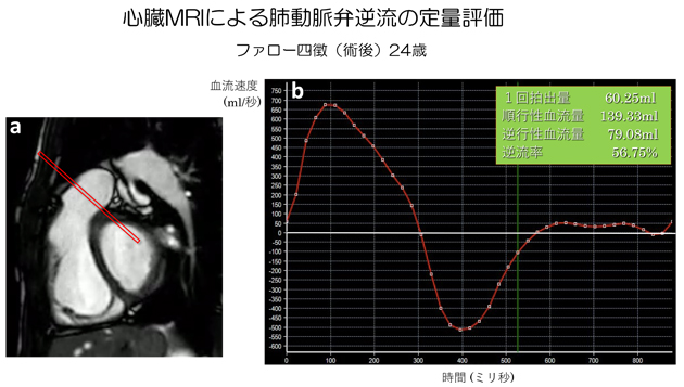 心臓MRIによる肺動脈弁逆流の定量評価