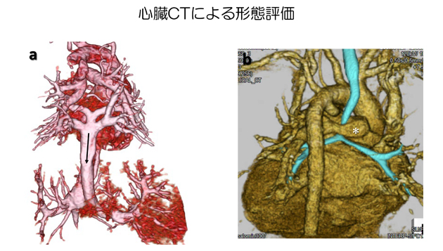 心臓CTによる形態評価