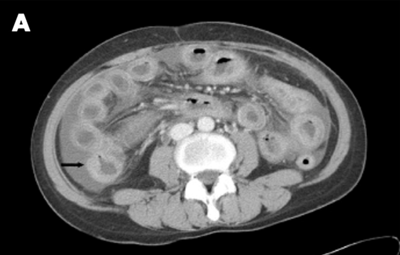初発のループス腸炎に対し 免疫抑制剤の併用は必要か？ │ 倉敷中央  