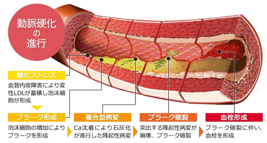 動脈硬化の進行