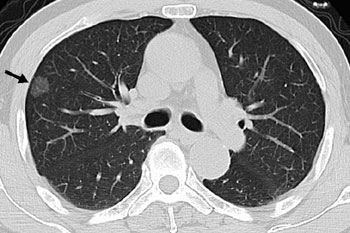 早期肺がん 撮像